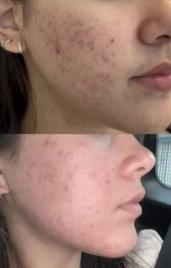 Antes e depois da pele da paciente: acne inflamada em cima, pele mais limpa embaixo