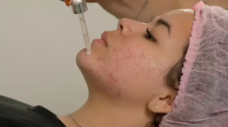 Aplicação de ativo no rosto da paciente com acne